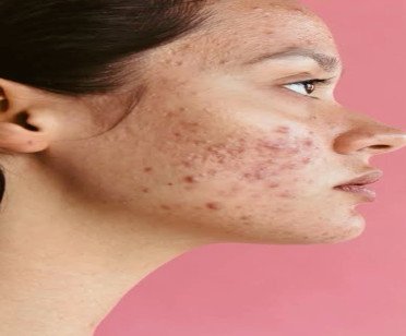 Acne-Prone Skin