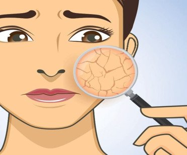 Dry Skin